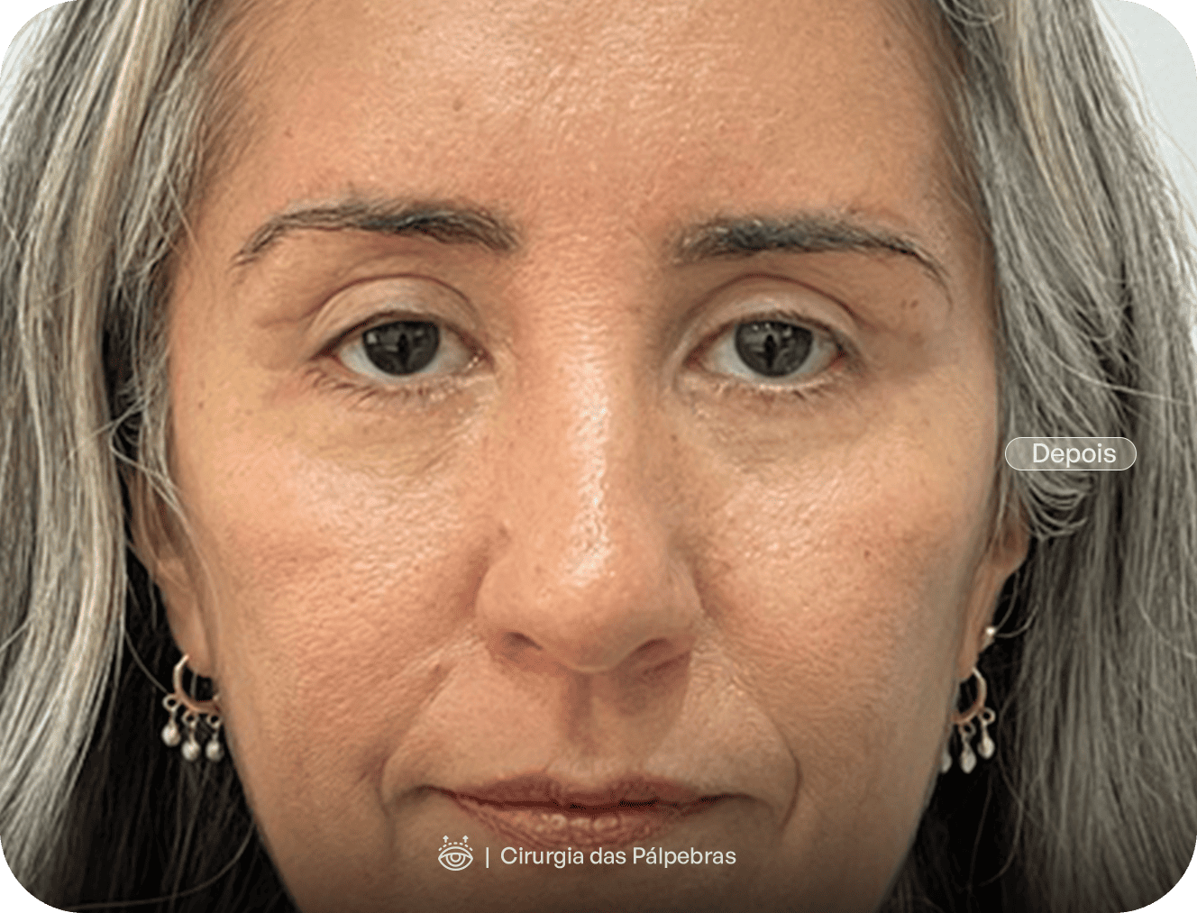 Blefaroplastia altera a expressão do rosto? Mitos e verdades